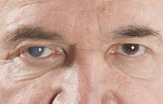 Como minimizar a perda visual por catarata em um olho